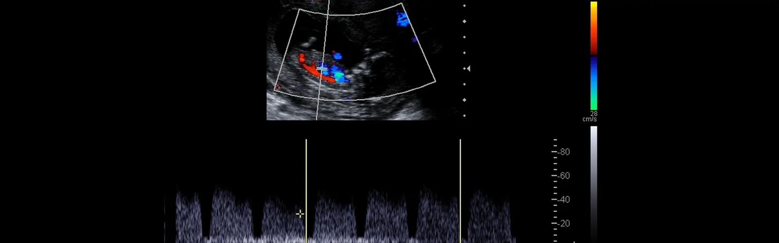 Why is Color Doppler Done For Pregnancy?